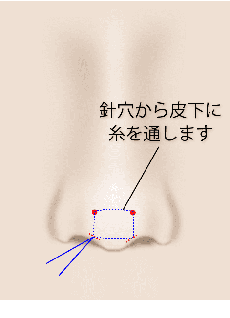 ②鼻の穴の中で糸を結ぶ